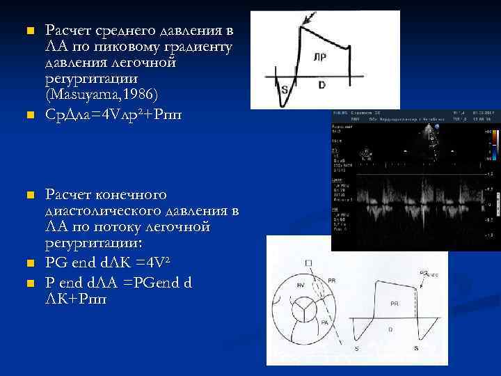n n n Расчет среднего давления в ЛА по пиковому градиенту давления легочной регургитации