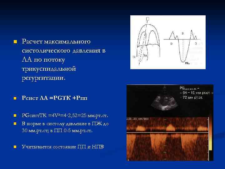 n Расчет максимального систолического давления в ЛА по потоку трикуспидальной регургитации. n Рсист ЛА