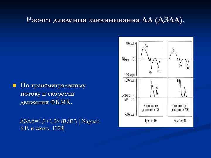 Расчет давления заклинивания ЛА (ДЗЛА). n По трансмитральному потоку и скорости движения ФКМК. ДЗЛА=1,