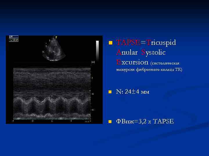n TAPSE=Tricuspid Anular Systolic Excursion (систолическая экскурсия фиброзного кольца ТК) n N: 24± 4