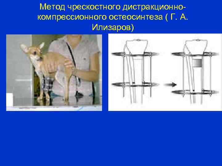 Метод чрескостного дистракционнокомпрессионного остеосинтеза ( Г. А. Илизаров) 