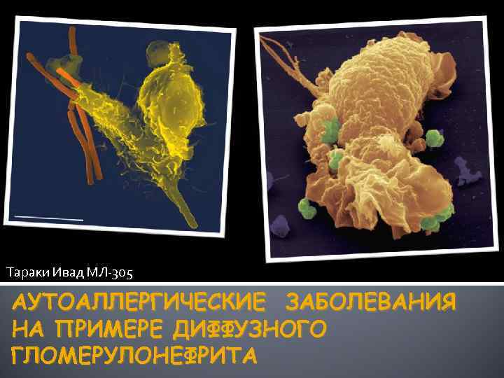 Тараки Ивад МЛ-305 АУТОАЛЛЕРГИЧЕСКИЕ ЗАБОЛЕВАНИЯ НА ПРИМЕРЕ ДИФФУЗНОГО ГЛОМЕРУЛОНЕФРИТА 