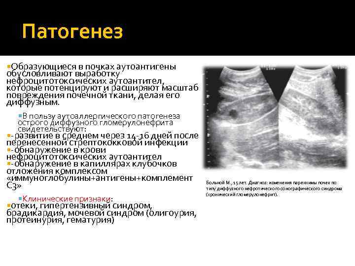 Патогенез Образующиеся в почках аутоантигены обусловливают выработку нефроцитотоксических аутоантител, которые потенцируют и расширяют масштаб