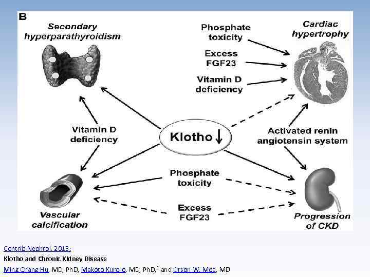 Contrib Nephrol. 2013; Klotho and Chronic Kidney Disease Ming Chang Hu, MD, Ph. D,