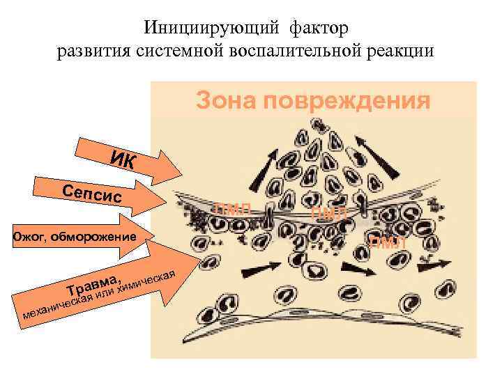 Инициирующий фактор развития системной воспалительной реакции Зона повреждения ИК Сепсис Ожог, обморожение а, имическая