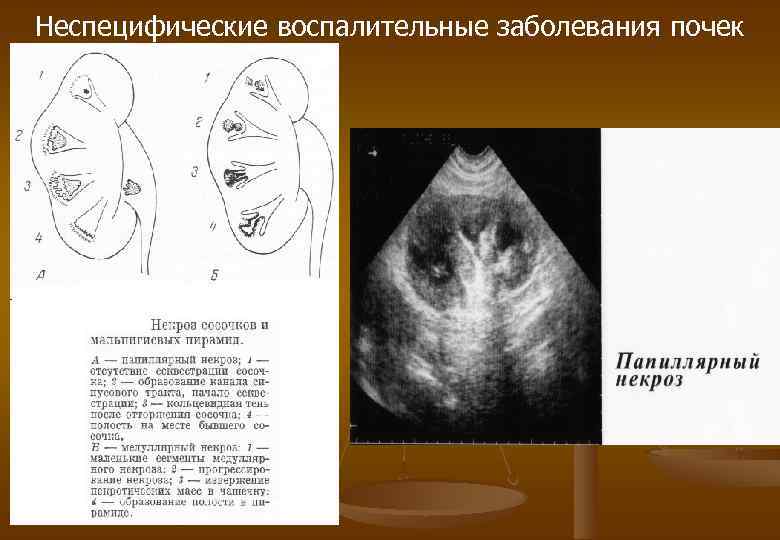 Неспецифические воспалительные заболевания почек 