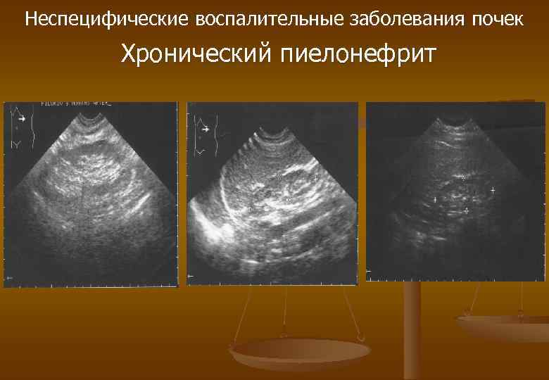 Неспецифические воспалительные заболевания почек Хронический пиелонефрит 