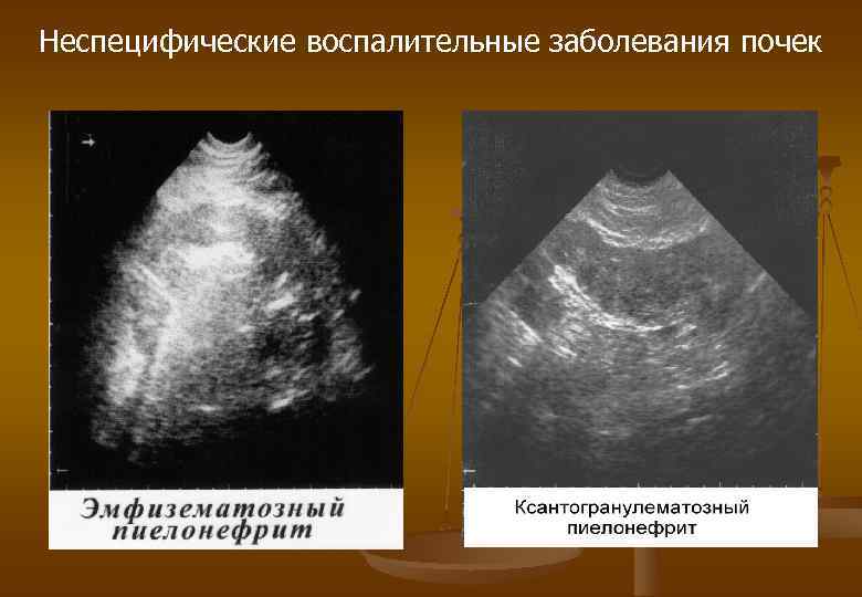 Неспецифические воспалительные заболевания почек 