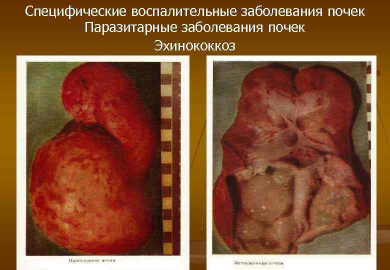 Специфические воспалительные заболевания почек Паразитарные заболевания почек Эхинококкоз 