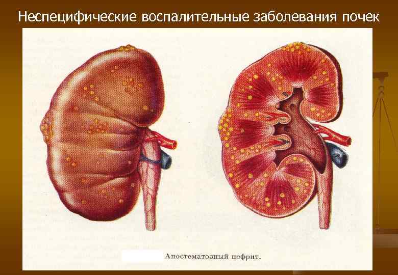 Неспецифические воспалительные заболевания почек 