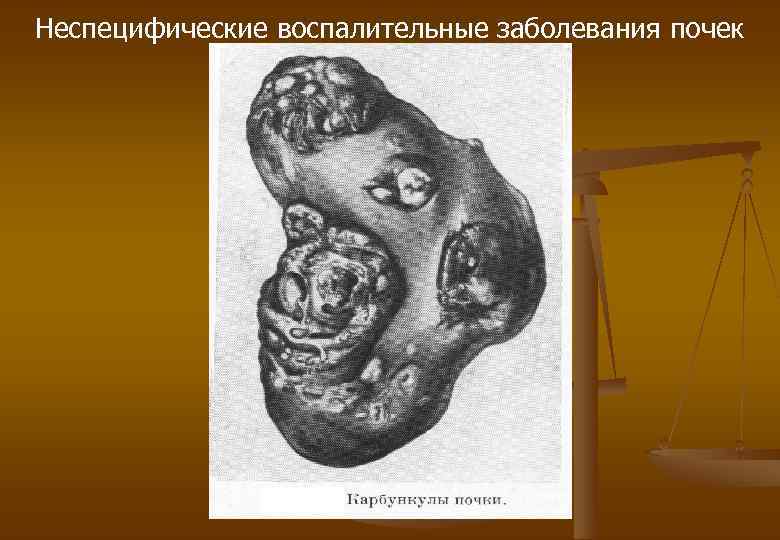 Неспецифические воспалительные заболевания почек 