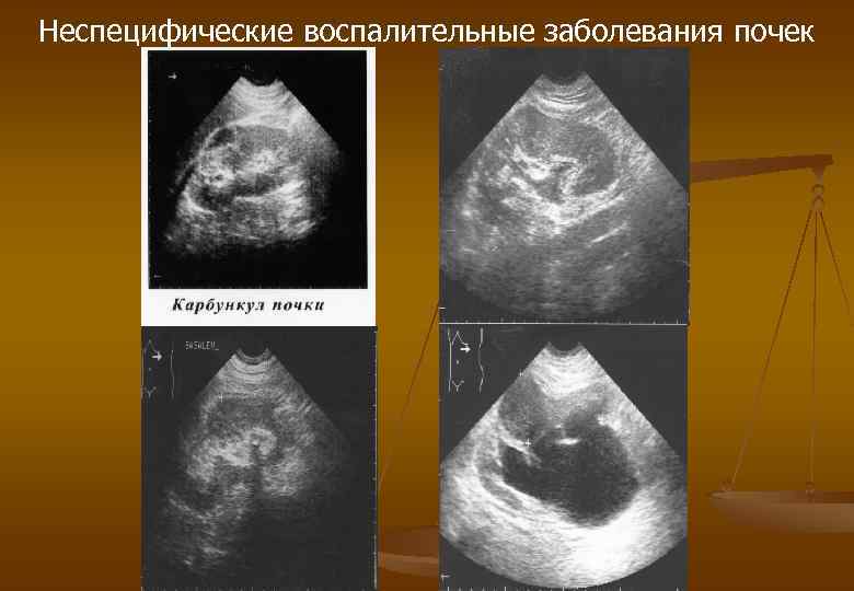 Неспецифические воспалительные заболевания почек 