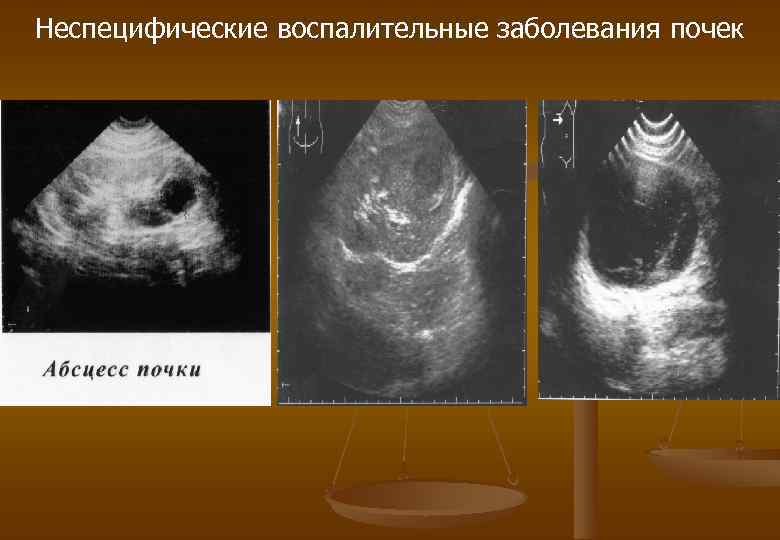 Неспецифические воспалительные заболевания почек 