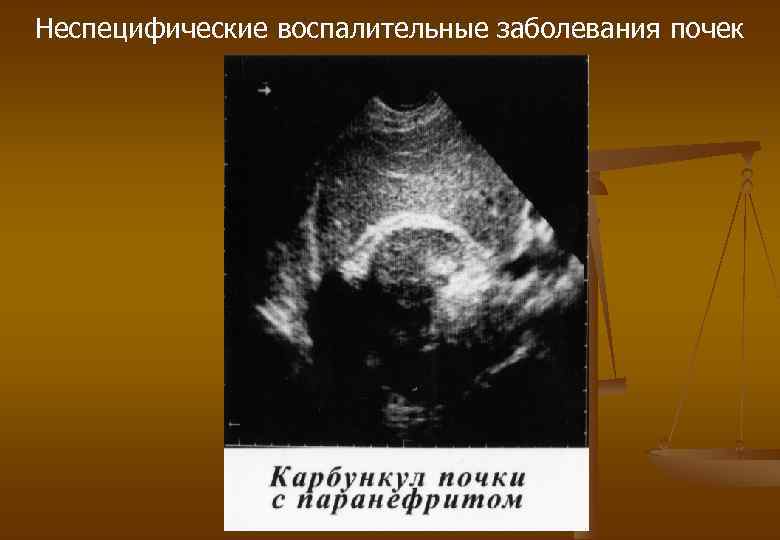 Неспецифические воспалительные заболевания почек 