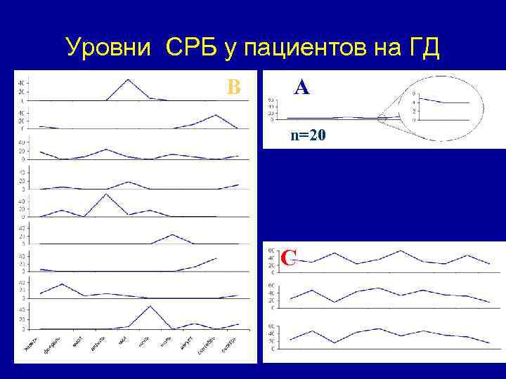 Уровни СРБ у пациентов на ГД B А n=20 C 