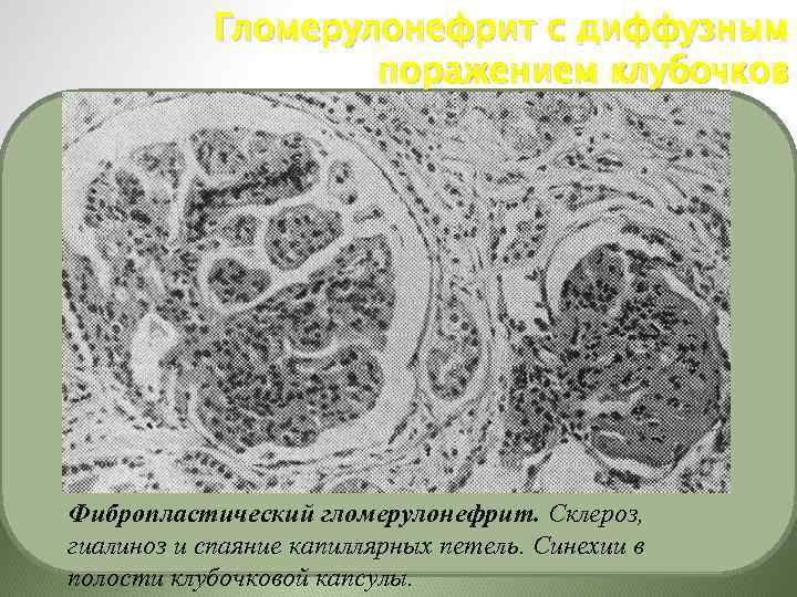 Острый гломерулонефрит картинки