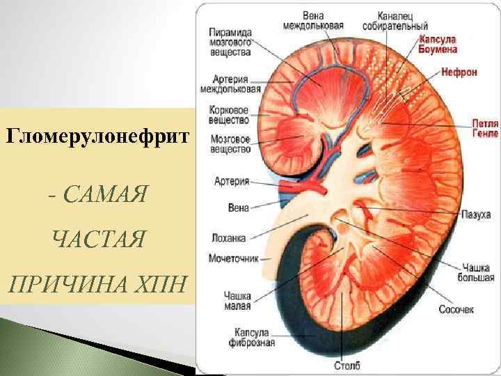 Гломерулонефрит - САМАЯ ЧАСТАЯ ПРИЧИНА ХПН 