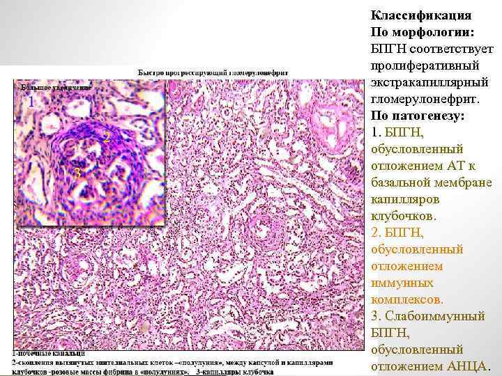 Классификация По морфологии: БПГН соответствует пролиферативный экстракапиллярный гломерулонефрит. По патогенезу: 1. БПГН, обусловленный отложением