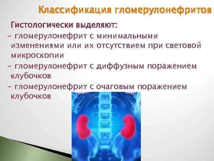 Классификация гломерулонефритов Гистологически выделяют: - гломерулонефрит с минимальными изменениями или их отсутствием при световой