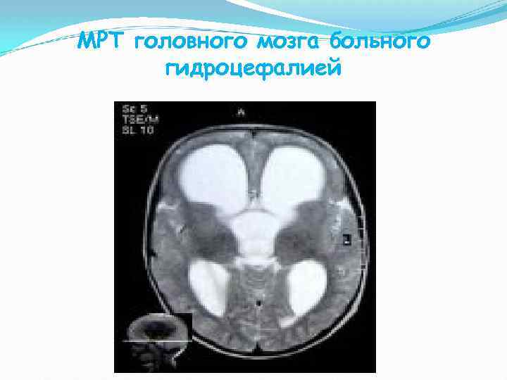 МРТ головного мозга больного гидроцефалией 