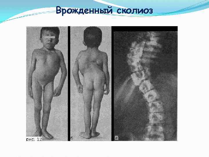 Врожденный сколиоз 