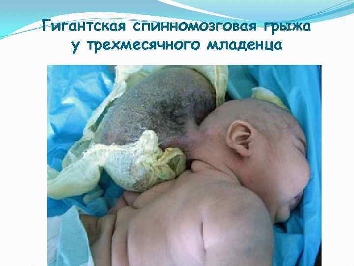 Гигантская спинномозговая грыжа у трехмесячного младенца 