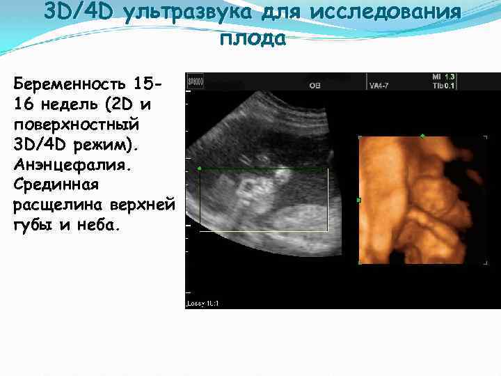 3 D/4 D ультразвука для исследования плода Беременность 1516 недель (2 D и поверхностный
