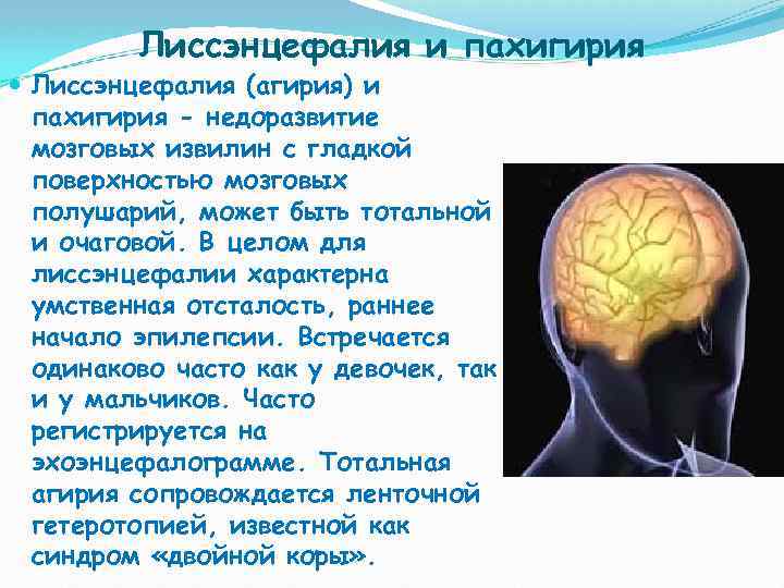 Лиссэнцефалия и пахигирия Лиссэнцефалия (агирия) и пахигирия - недоразвитие мозговых извилин с гладкой поверхностью