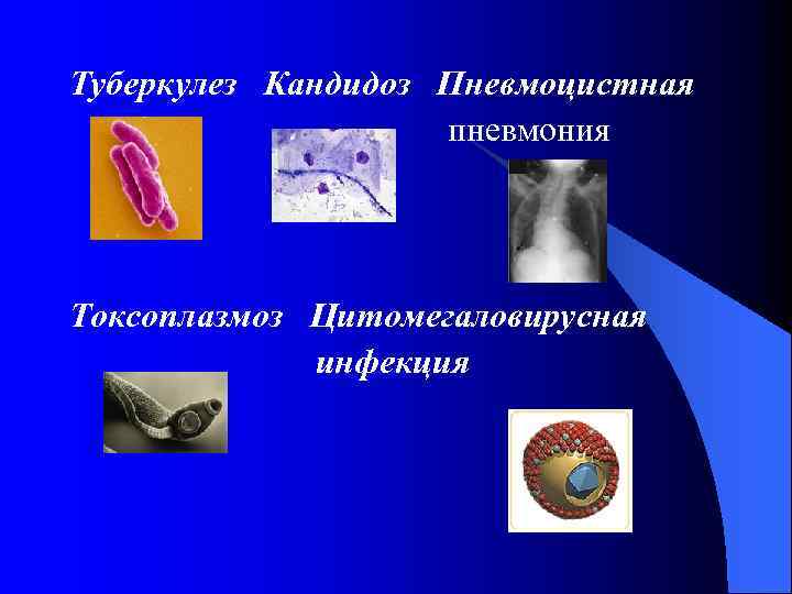 Туберкулез Кандидоз Пневмоцистная пневмония Токсоплазмоз Цитомегаловирусная инфекция 