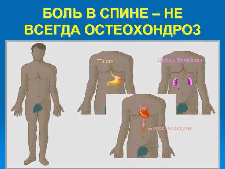 БОЛЬ В СПИНЕ – НЕ ВСЕГДА ОСТЕОХОНДРОЗ 