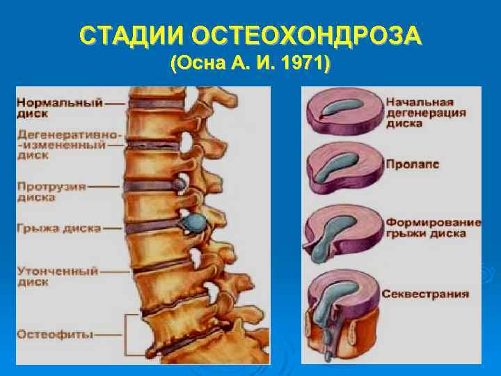 СТАДИИ ОСТЕОХОНДРОЗА (Осна А. И. 1971) 