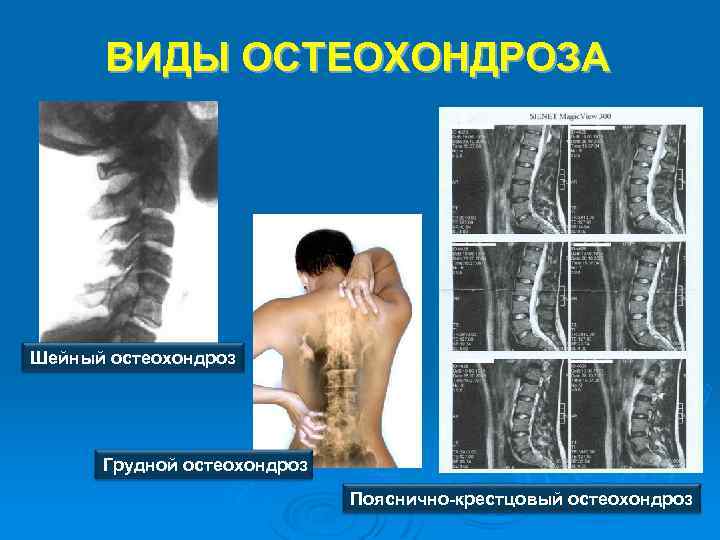 ВИДЫ ОСТЕОХОНДРОЗА Шейный остеохондроз Грудной остеохондроз Пояснично-крестцовый остеохондроз 