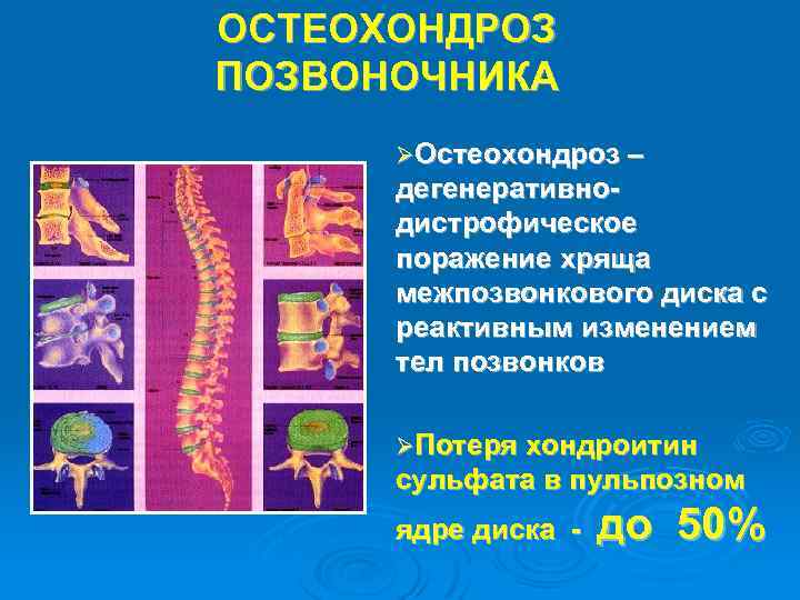 ОСТЕОХОНДРОЗ ПОЗВОНОЧНИКА ØОстеохондроз – дегенеративнодистрофическое поражение хряща межпозвонкового диска с реактивным изменением тел позвонков