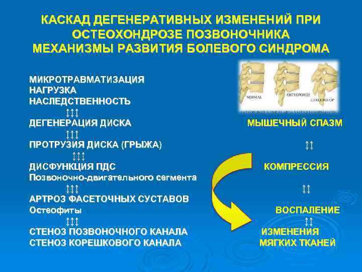 КАСКАД ДЕГЕНЕРАТИВНЫХ ИЗМЕНЕНИЙ ПРИ ОСТЕОХОНДРОЗЕ ПОЗВОНОЧНИКА МЕХАНИЗМЫ РАЗВИТИЯ БОЛЕВОГО СИНДРОМА МИКРОТРАВМАТИЗАЦИЯ НАГРУЗКА НАСЛЕДСТВЕННОСТЬ ↕↕↕