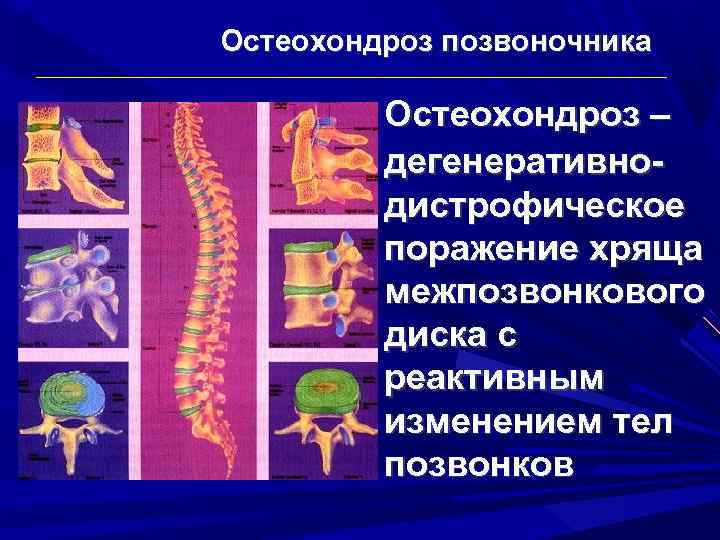 Остеохондроз позвоночника Остеохондроз – дегенеративнодистрофическое поражение хряща межпозвонкового диска с реактивным изменением тел позвонков