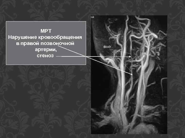 МРТ Нарушение кровообращения в правой позвоночной артерии, стеноз 