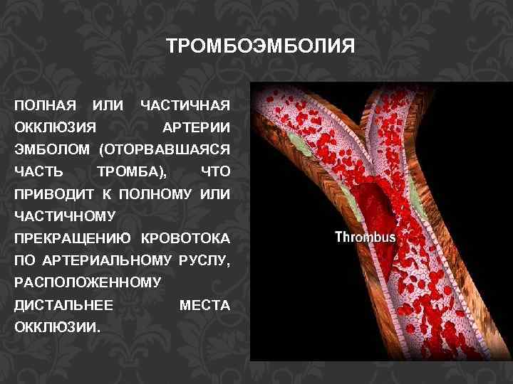 ТРОМБОЭМБОЛИЯ ПОЛНАЯ ИЛИ ЧАСТИЧНАЯ ОККЛЮЗИЯ АРТЕРИИ ЭМБОЛОМ (ОТОРВАВШАЯСЯ ЧАСТЬ ТРОМБА), ЧТО ПРИВОДИТ К ПОЛНОМУ