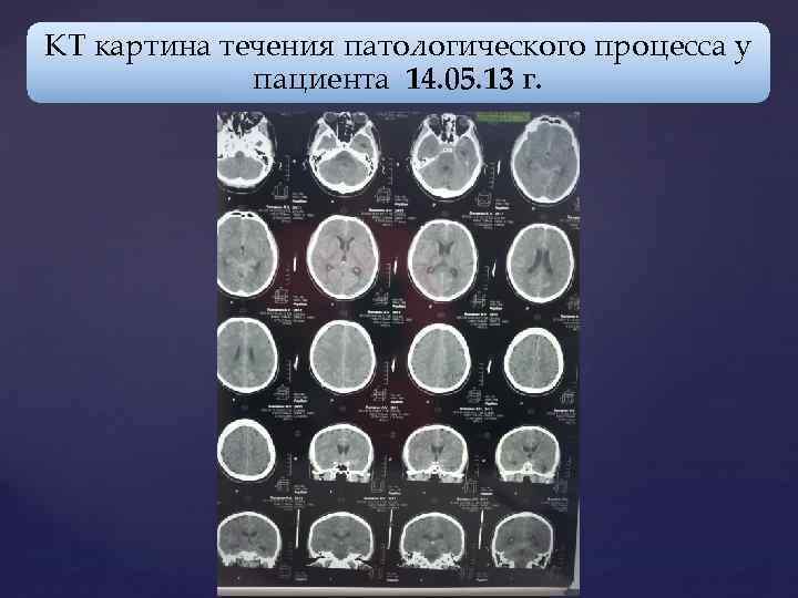 КТ картина течения патологического процесса у пациента в динамике: 14. 05. 13 пациента 14.