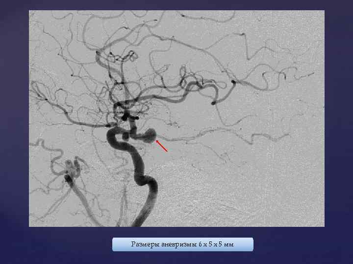 Размеры аневризмы 6 х 5 мм 