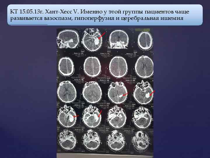 КТ 15. 05. 13 г. Хант-Хесс V. Именно у этой группы пациентов чаще развивается