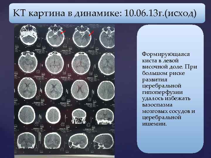 КТ картина в динамике: 10. 06. 13 г. (исход) Формирующаяся киста в левой височной