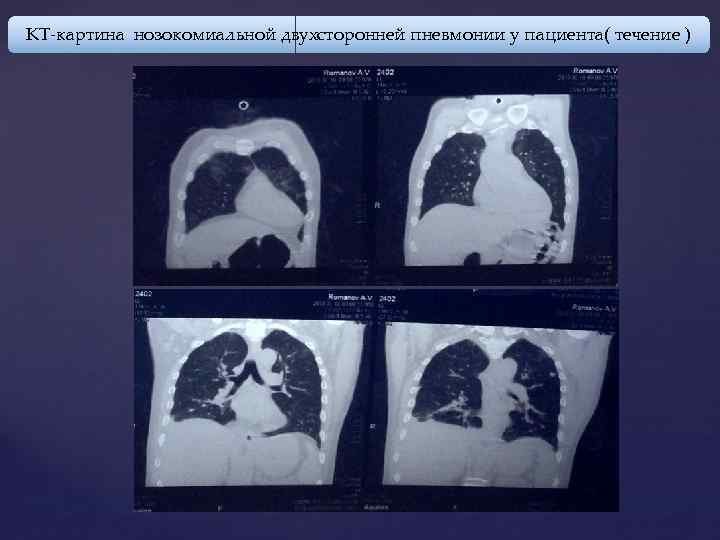 КТ-картина нозокомиальной двухсторонней пневмонии у пациента( течение ) 