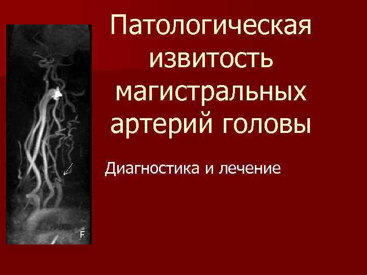 Патологическая извитость магистральных артерий головы Диагностика и лечение 