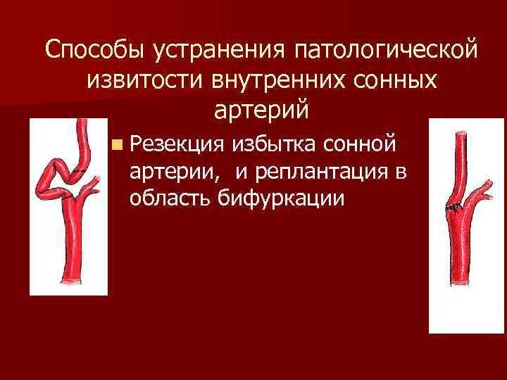 Способы устранения патологической извитости внутренних сонных артерий n Резекция избытка сонной артерии, и реплантация