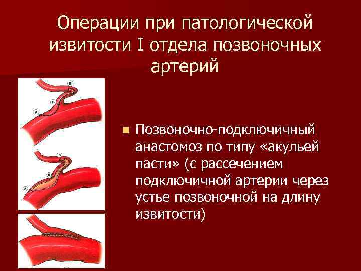 Операции при патологической извитости I отдела позвоночных артерий n Позвоночно-подключичный анастомоз по типу «акульей