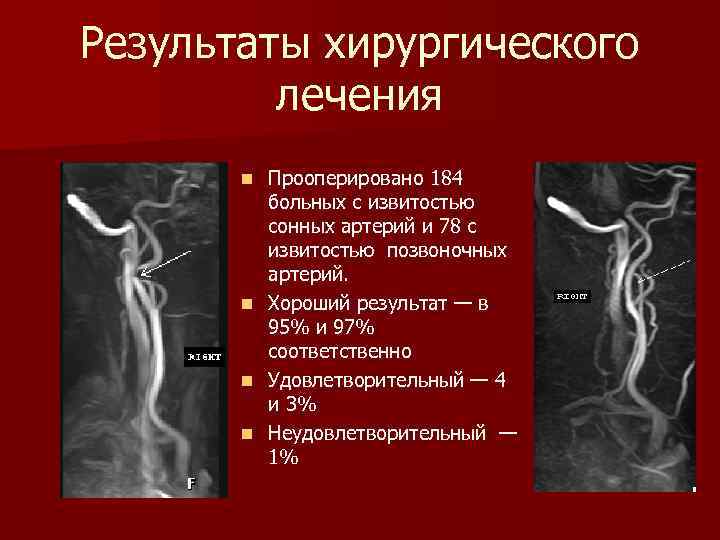 Результаты хирургического лечения n n Прооперировано 184 больных с извитостью сонных артерий и 78