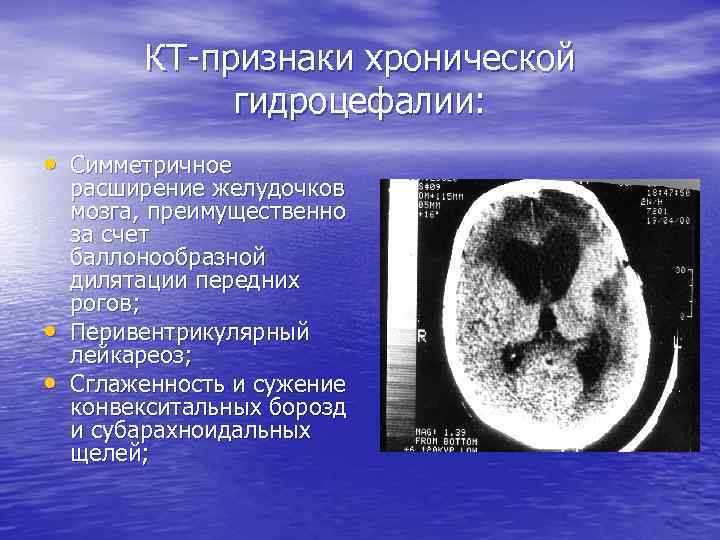 КТ-признаки хронической гидроцефалии: • Симметричное • • расширение желудочков мозга, преимущественно за счет баллонообразной