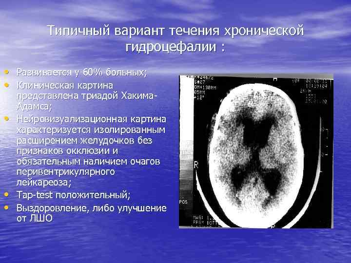 Типичный вариант течения хронической гидроцефалии : • Развивается у 60% больных; • Клиническая картина