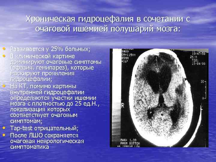 Хроническая гидроцефалия в сочетании с очаговой ишемией полушарий мозга: • Развивается у 25% больных;