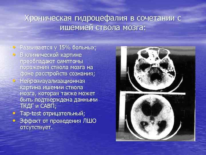 Хроническая гидроцефалия в сочетании с ишемией ствола мозга: • Развивается у 15% больных; •